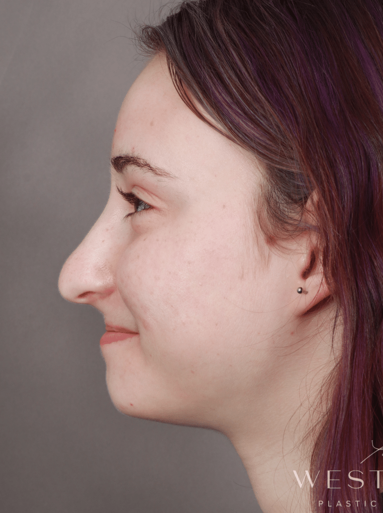 Before Image: Open Rhinoplasty (8.5 Months Post-op) - left-side