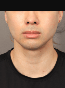 After Image: Buccal Fat Removal (2 Months Post-op)