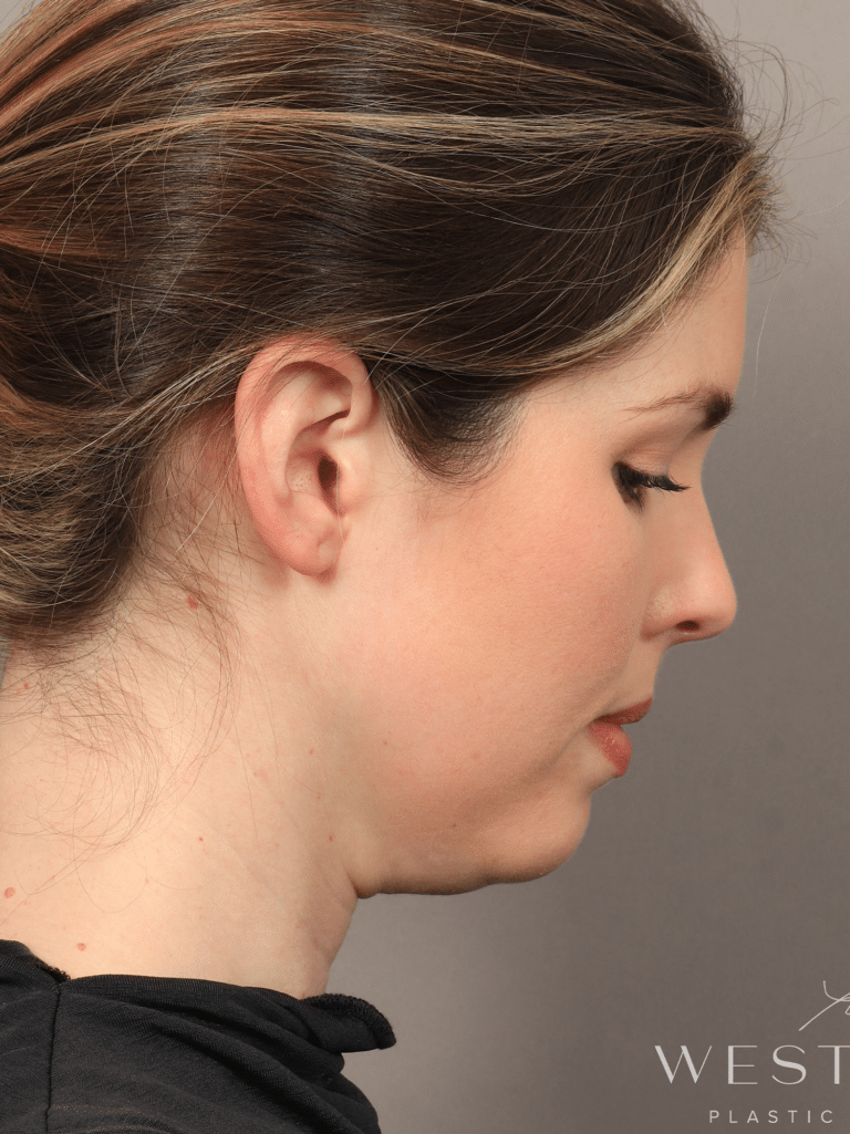 Before Image: Liposuction & Renuvion Skin Tightening (10 Days Post-op) - right-side