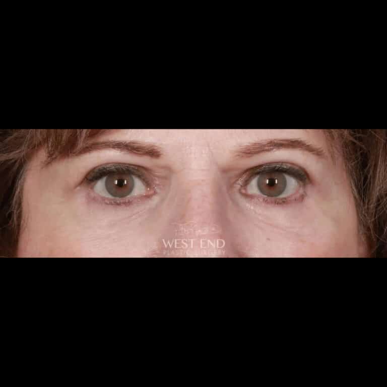 After Image: Lower & Upper Blepharoplasty - front