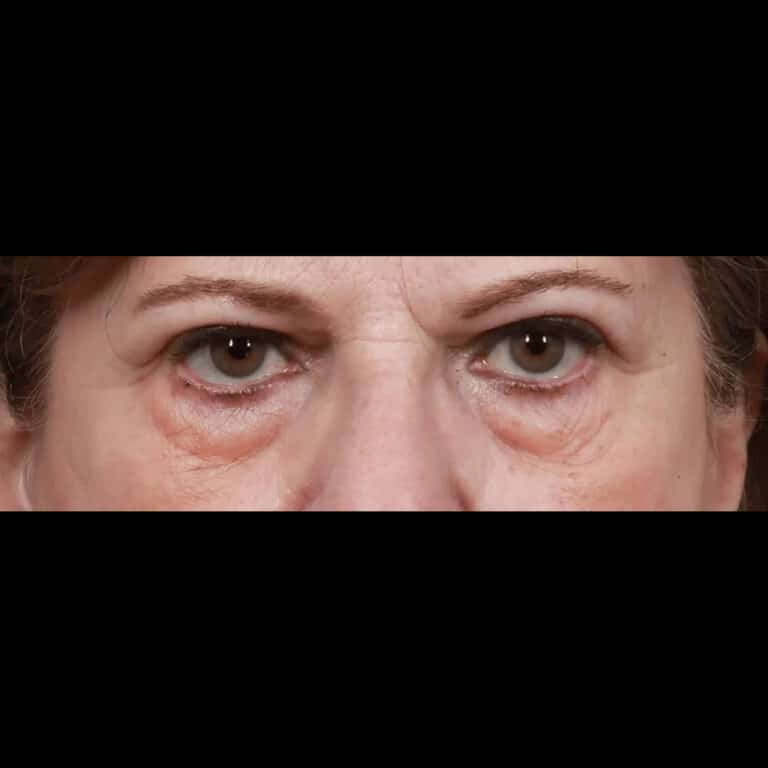 Before Image: Lower & Upper Blepharoplasty - front