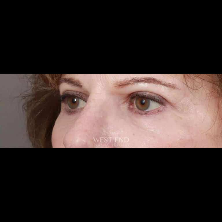 After Image: Lower & Upper Blepharoplasty - left-front-oblique