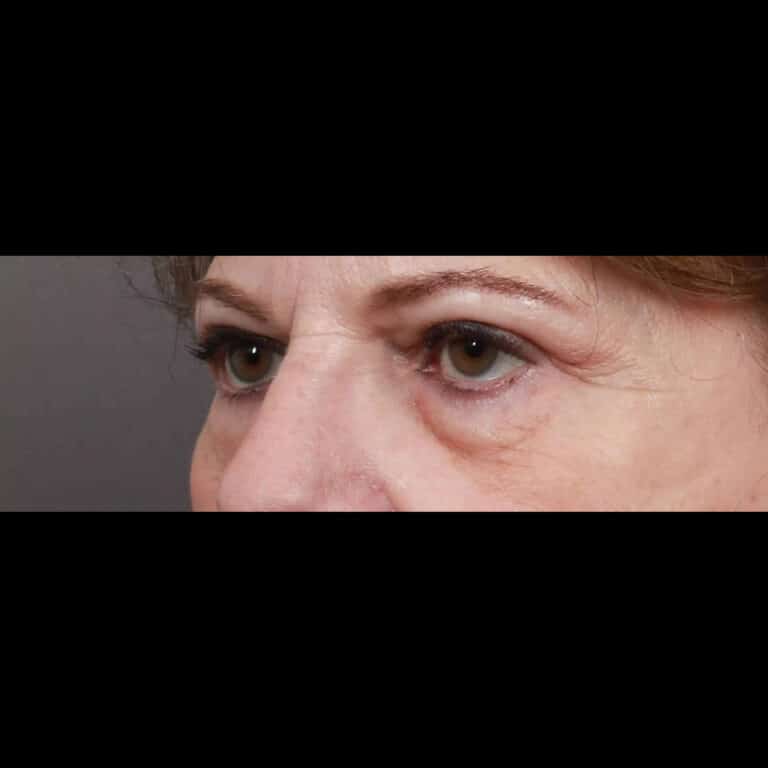 Before Image: Lower & Upper Blepharoplasty - left-front-oblique