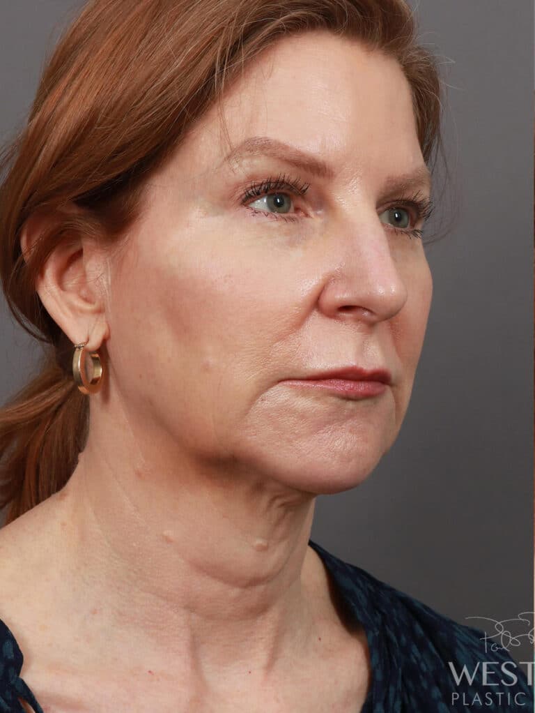 Before Image: Deep Plane Facelift & Neck Lift, Brow Lift, Upper Eyelid Lift, Fat Grafting, and CO2 Resurfacing (5 Months Post-Op) - right-side