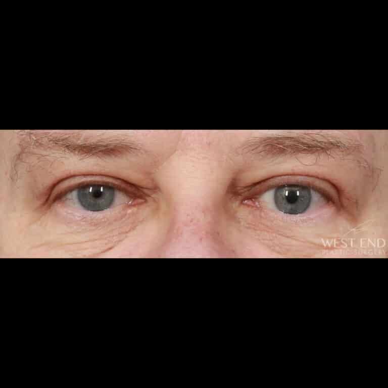 After Image: Upper Eyelid Lift & Brow Lift (2 weeks post-op) - front