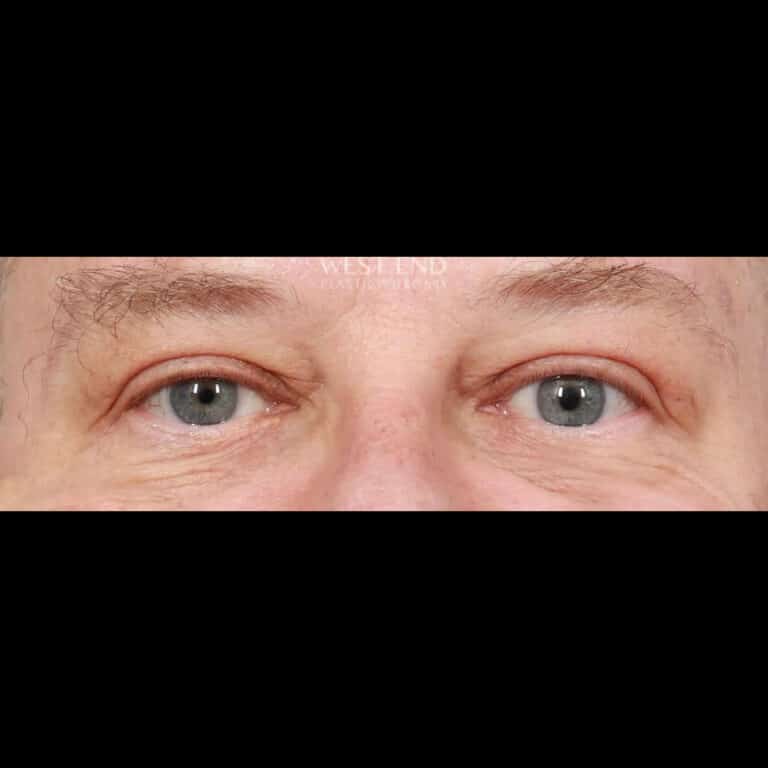 After Image: Upper Eyelid Lift & Brow Lift (3 Months Post-op) - front