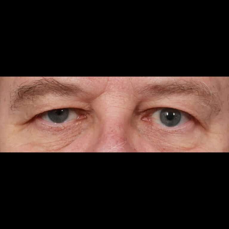 Before Image: Upper Eyelid Lift & Brow Lift (3 Months Post-op) - front