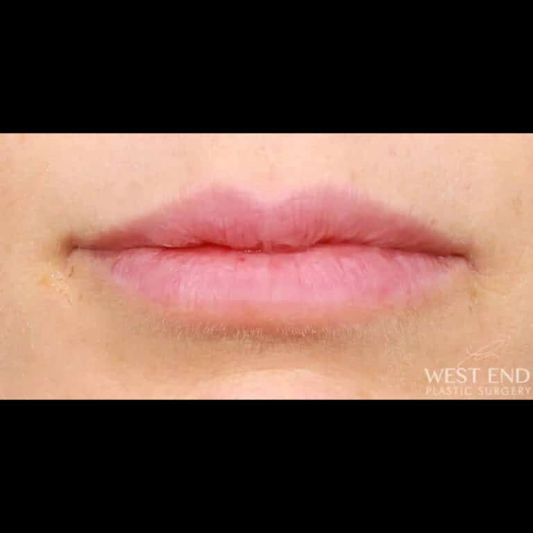 After Image: Lip Filler - front