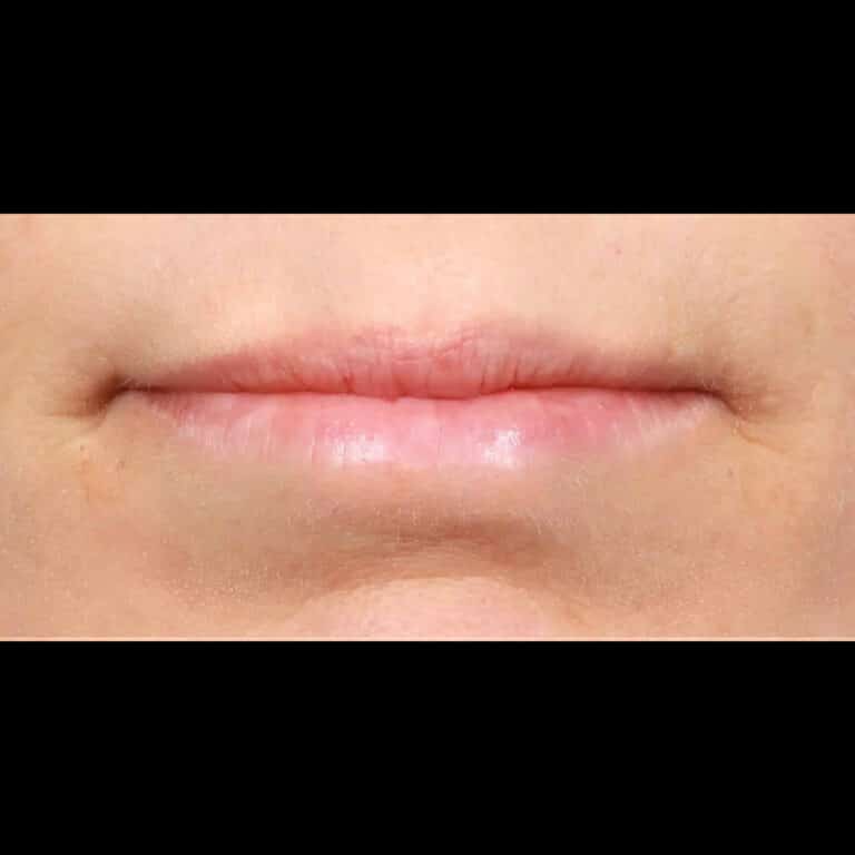 Before Image: Lip Filler - front
