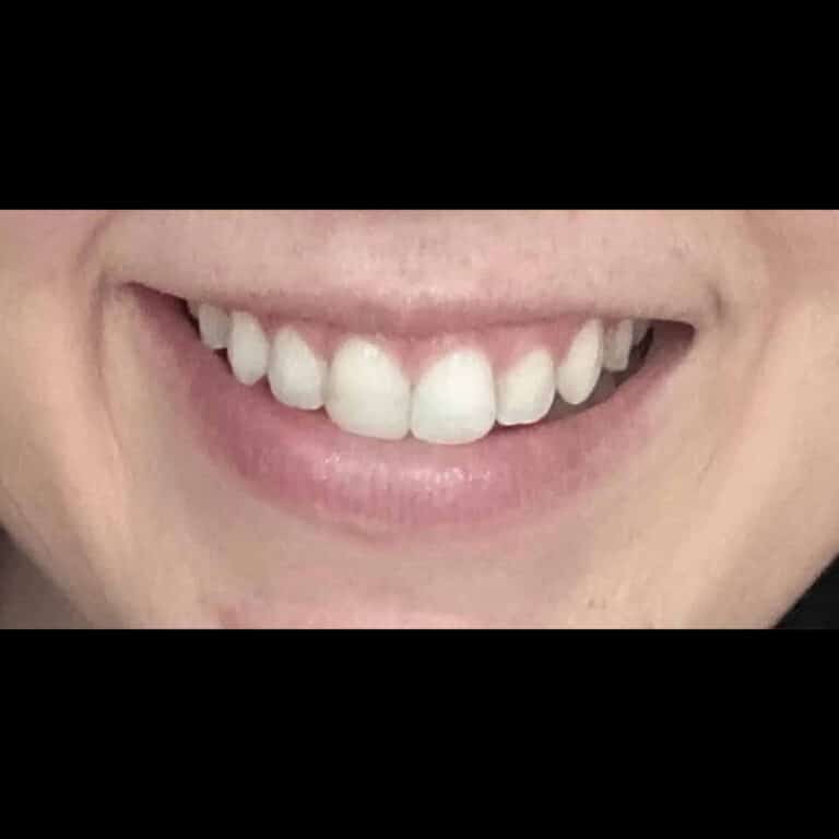 Before Image: Lip Flip - front