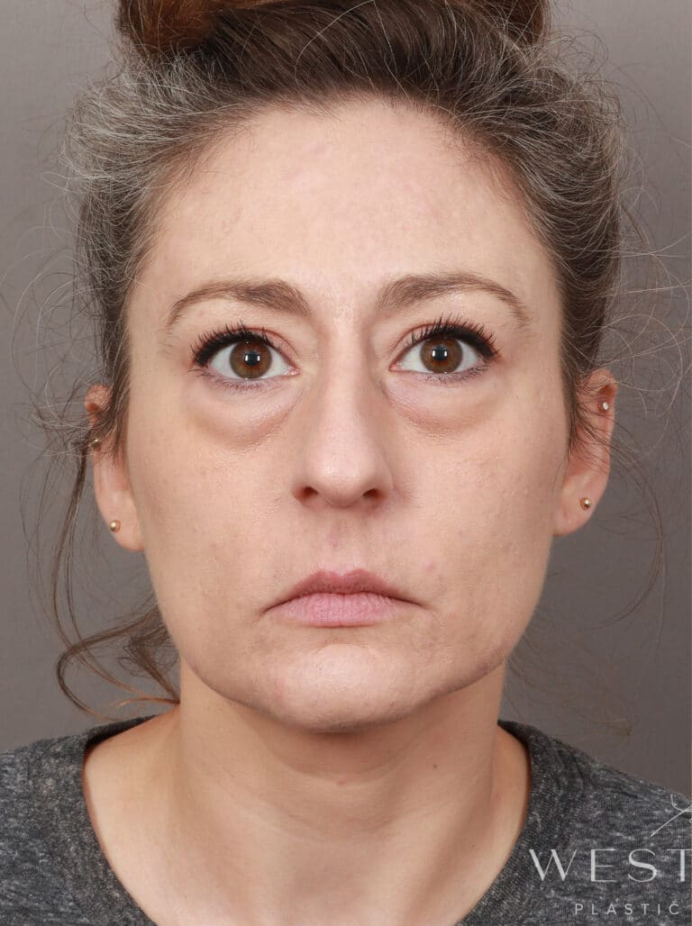 Before Image: Deep Plane Facelift and Neck Lift, Upper/Lower Blepharoplasty (Eyelid Lift), Buccal Fat Removal, Temporal Brow Lift, Fat Grafting, and CO2 Laser Resurfacing. (1 Month Post-op) - front