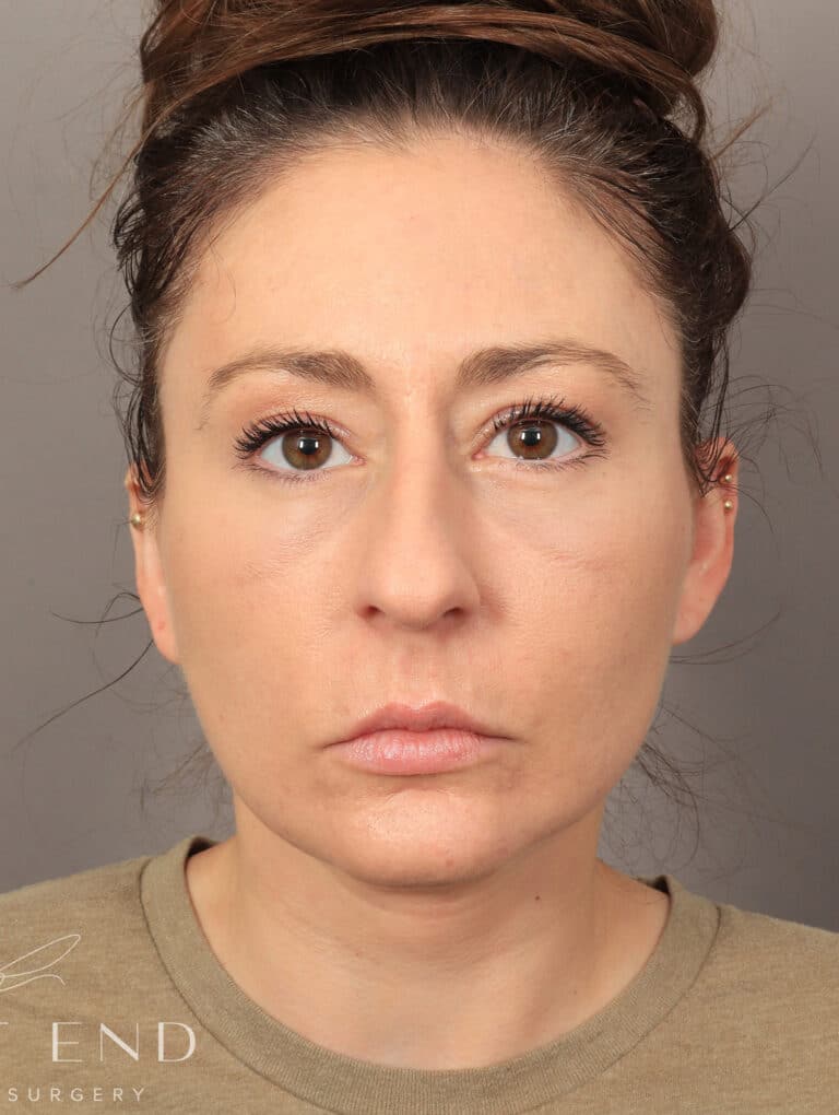 After Image: Deep Plane Facelift and Neck Lift, Upper/Lower Blepharoplasty (Eyelid Lift), Buccal Fat Removal, Temporal Brow Lift, Fat Grafting, and CO2 Laser Resurfacing. (1 Month Post-op) - front