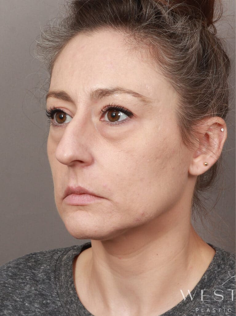 Before Image: Deep Plane Facelift and Neck Lift, Upper/Lower Blepharoplasty (Eyelid Lift), Buccal Fat Removal, Temporal Brow Lift, Fat Grafting, and CO2 Laser Resurfacing. (1 Month Post-op) - left-front-oblique