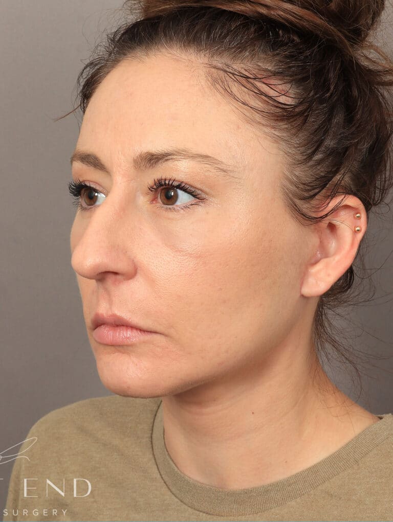 After Image: Deep Plane Facelift and Neck Lift, Upper/Lower Blepharoplasty (Eyelid Lift), Buccal Fat Removal, Temporal Brow Lift, Fat Grafting, and CO2 Laser Resurfacing. (1 Month Post-op) - left-front-oblique