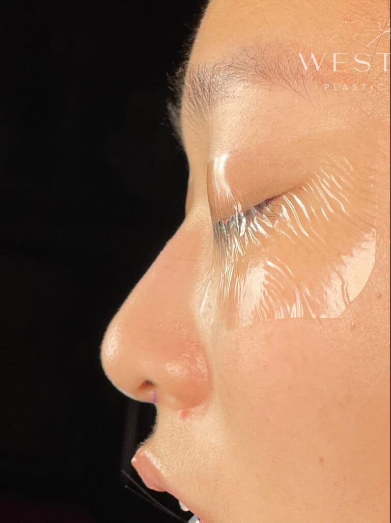 Before Image: Asian Rhinoplasty with Rib Cartilage (Immediately Post-op) - left-side