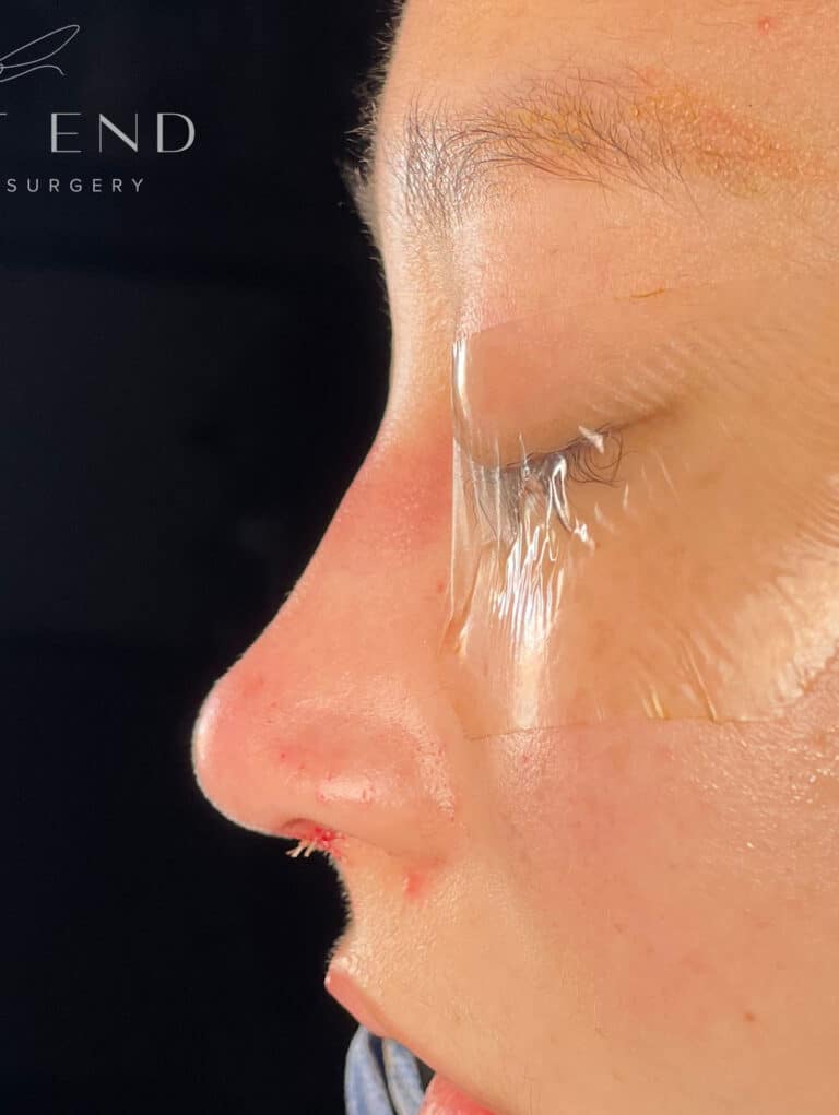 After Image: Asian Rhinoplasty with Rib Cartilage (Immediately Post-op) - left-side
