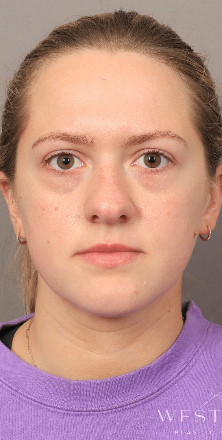 Before Image: Under-Eye & Cheek Filler - front