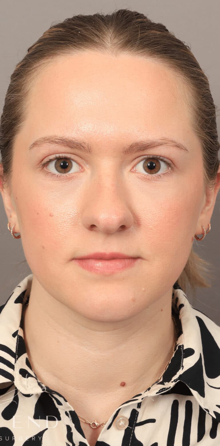 After Image: Under-Eye & Cheek Filler - front