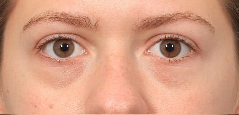 Before Image: Under-Eye & Cheek Filler - front