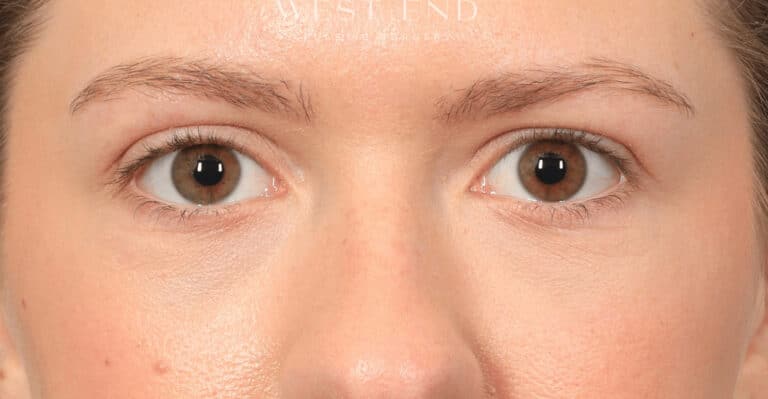 After Image: Under-Eye & Cheek Filler - front