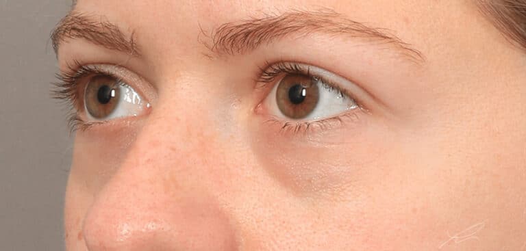 Before Image: Under-Eye & Cheek Filler - left-front-oblique