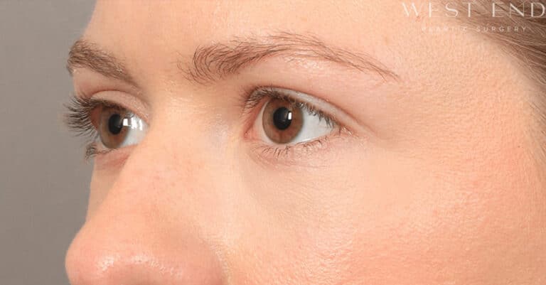After Image: Under-Eye & Cheek Filler - left-front-oblique