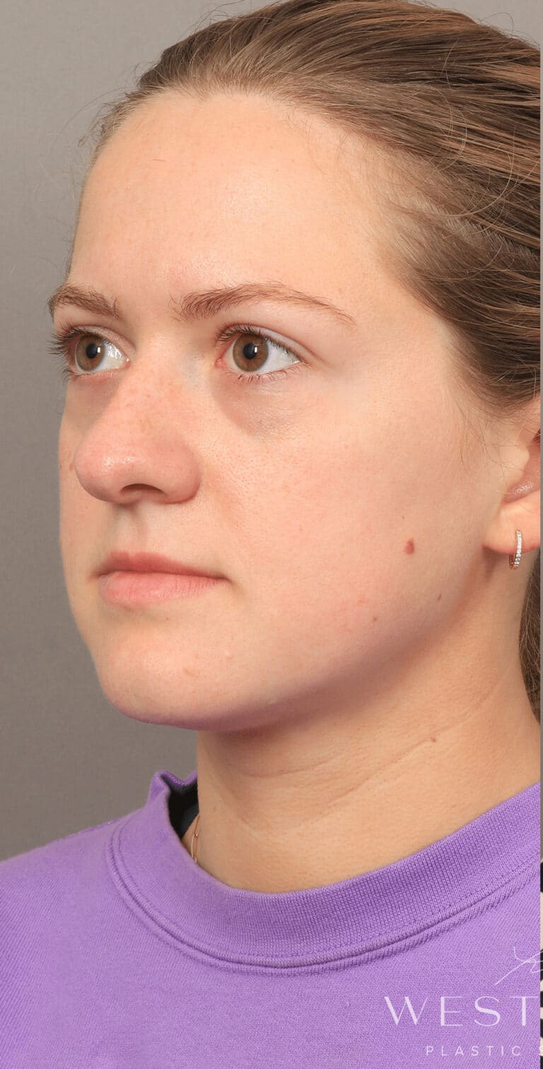 Before Image: Under-Eye & Cheek Filler - left-front-oblique
