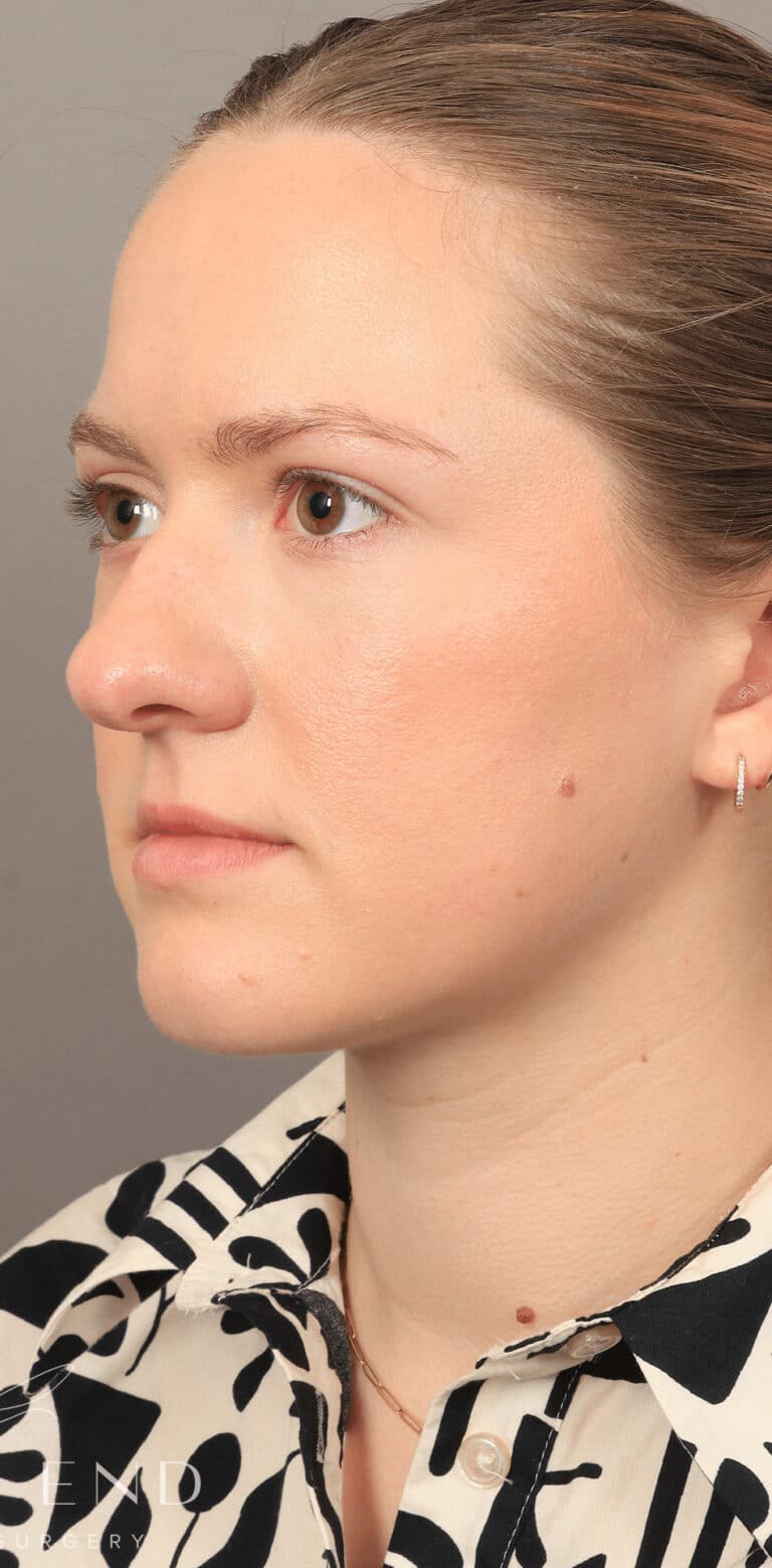 After Image: Under-Eye & Cheek Filler - left-front-oblique