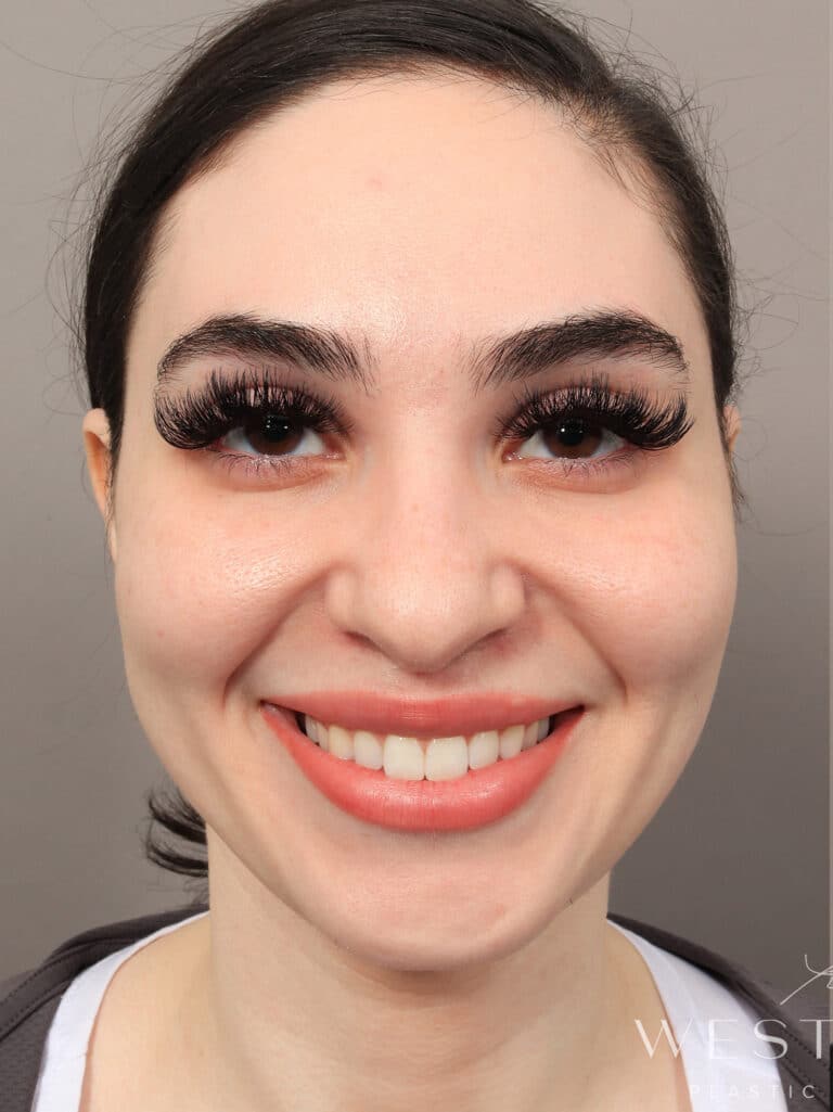 Before Image: Rhinoplasty & Facial Fat Grafting (2 Months Post-op) - front