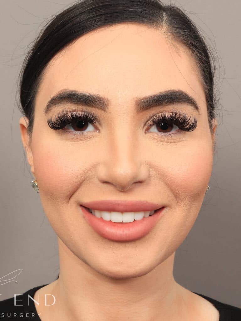 After Image: Rhinoplasty & Facial Fat Grafting (2 Months Post-op) - front