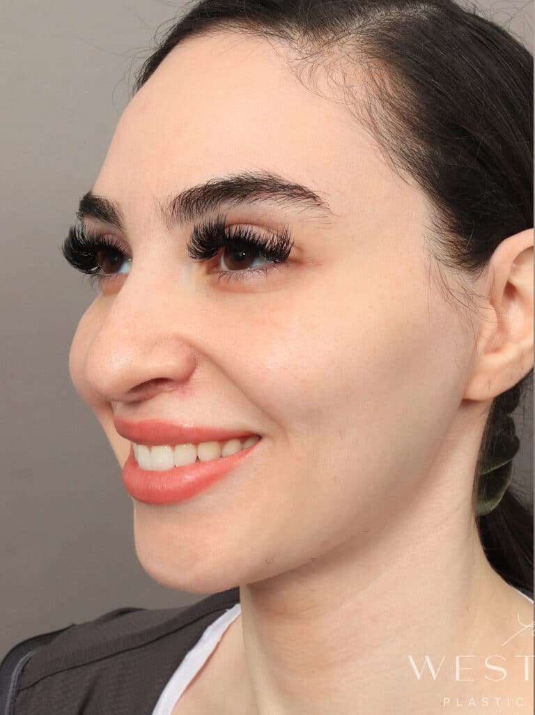 Before Image: Rhinoplasty & Facial Fat Grafting (2 Months Post-op) - left-front-oblique