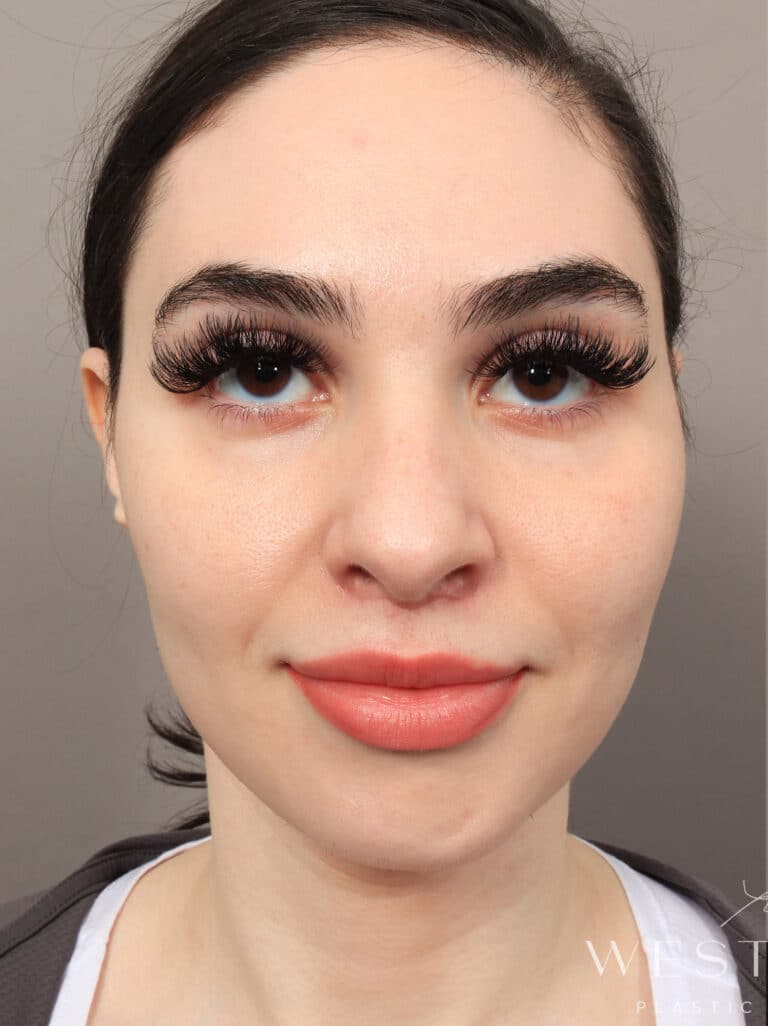 Before Image: Rhinoplasty & Facial Fat Grafting (2 Months Post-op) - front