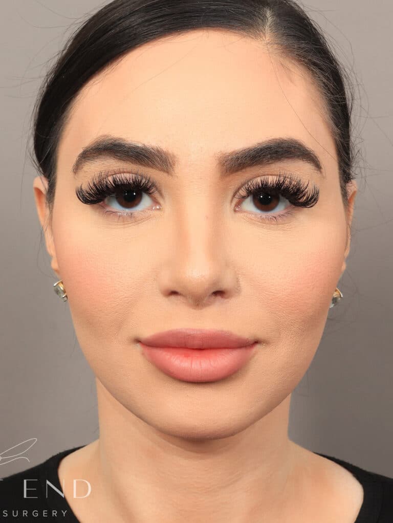 After Image: Rhinoplasty & Facial Fat Grafting (2 Months Post-op) - front