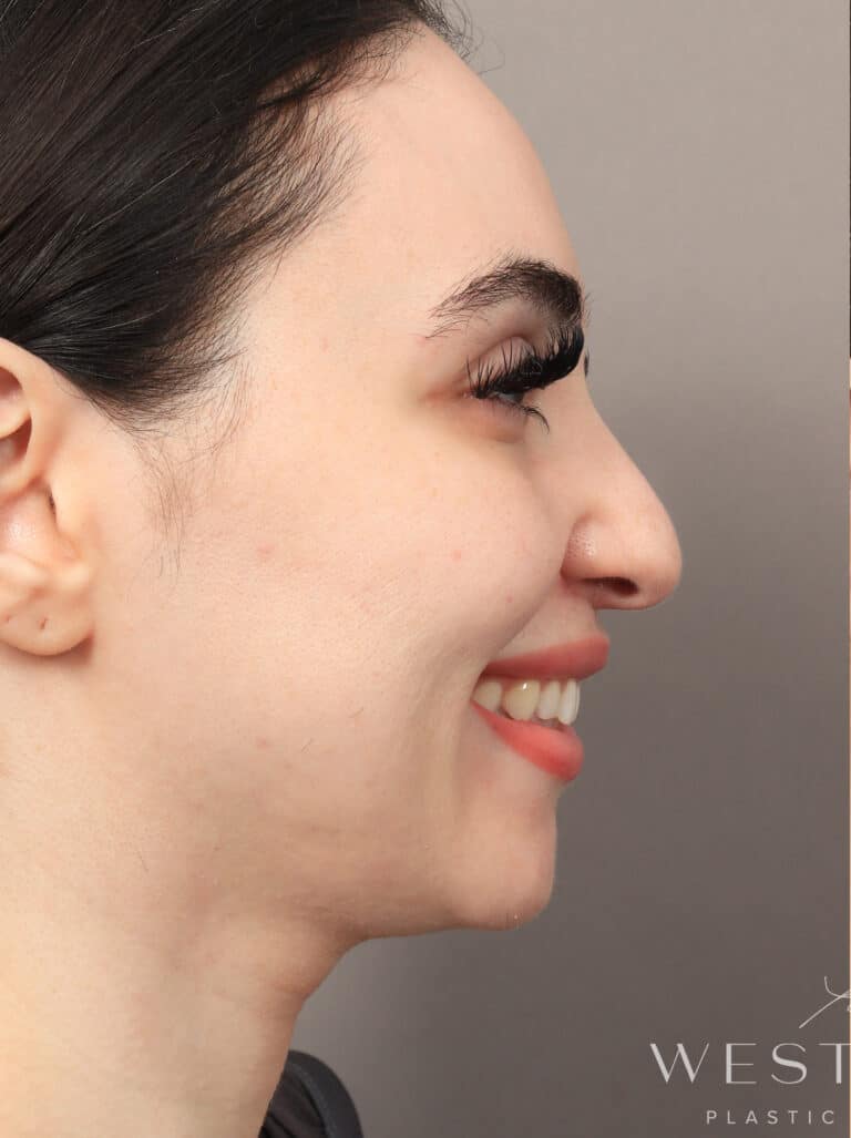 Before Image: Rhinoplasty & Facial Fat Grafting (2 Months Post-op) - right-side