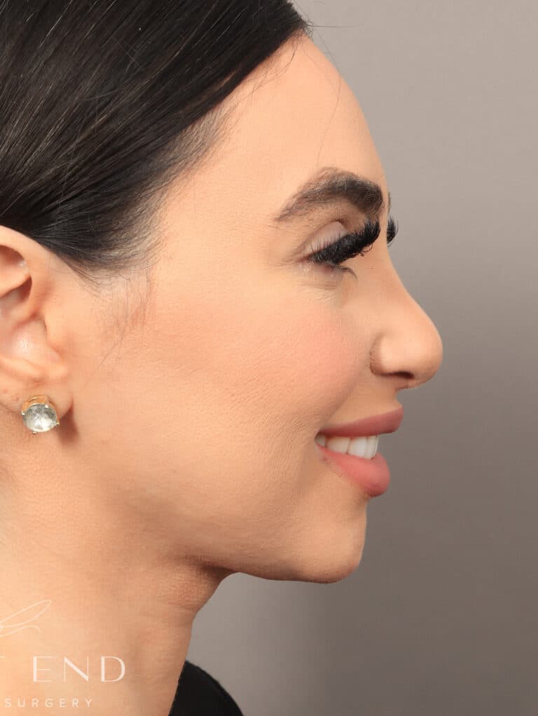 After Image: Rhinoplasty & Facial Fat Grafting (2 Months Post-op) - right-side