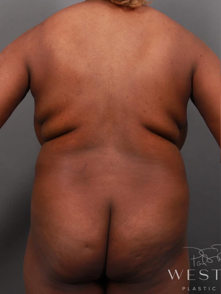Before Image: Liposuction and Renuvion Skin Tightening (10 Months Post-op) - back