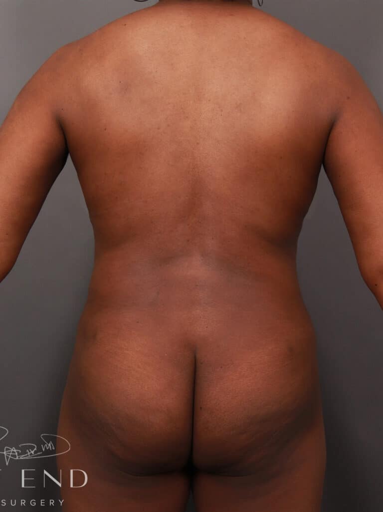 After Image: Liposuction and Renuvion Skin Tightening (10 Months Post-op) - back