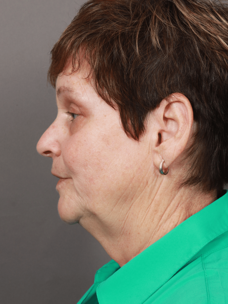 Before Image: Deep Plane Facelift & Neck Lift, Brow Lift, Eyelid Lift, Lip Lift, Fat Grafting, and CO2 Resurfacing (1 Year Post-Op) - left-side
