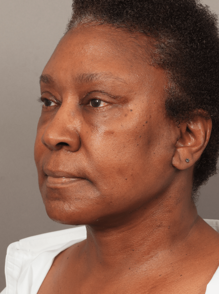After Image: Lower Face & Neck Lift, Upper Eyelid Lift, Brow Lift, and Fat Grafting (2 Weeks Post-op) - left-front-oblique