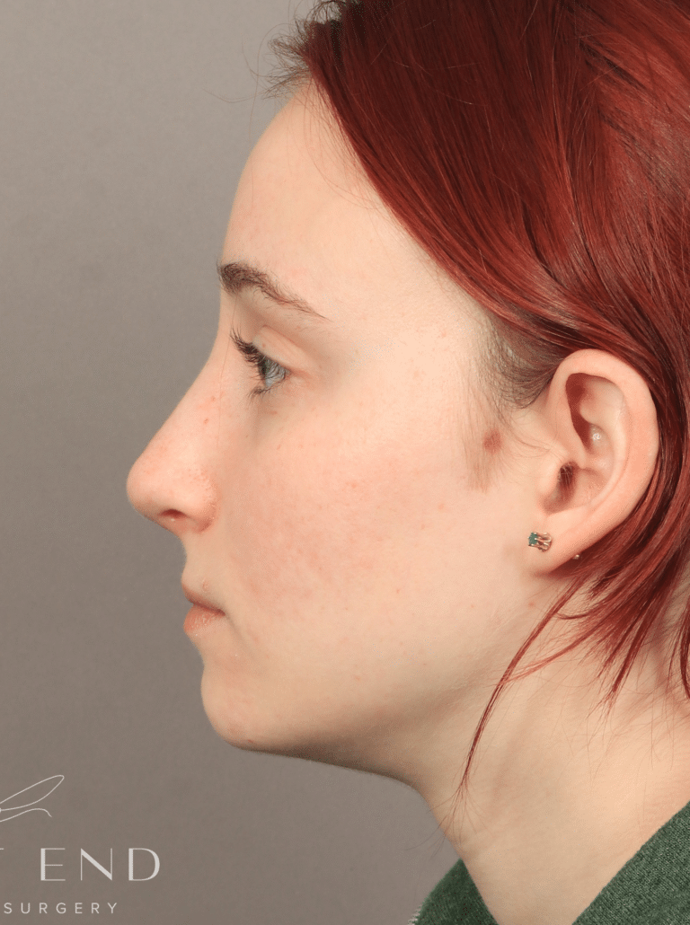 After Image: Open Rhinoplasty (8.5 Months Post-op) - left-side