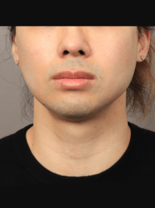 Before Image: Buccal Fat Removal (2 Months Post-op)
