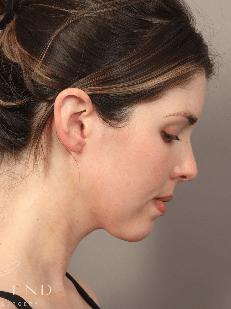 After Image: Liposuction & Renuvion Skin Tightening (10 Days Post-op) - right-side