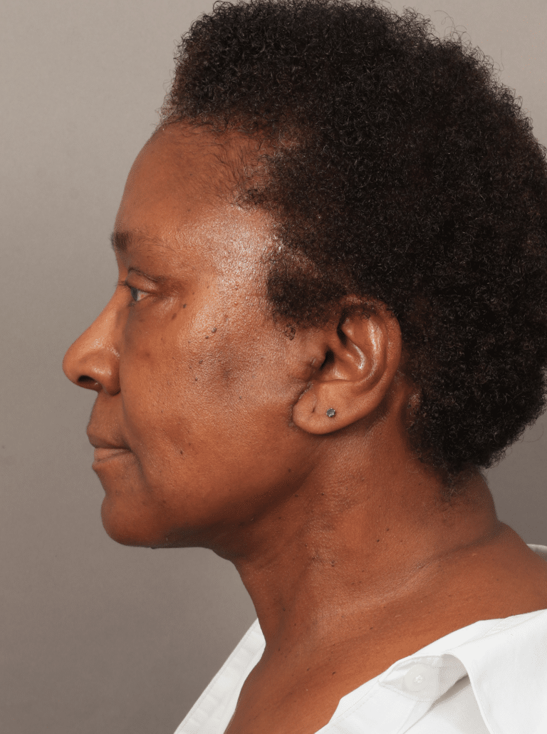 After Image: Lower Face & Neck Lift, Upper Eyelid Lift, Brow Lift, and Fat Grafting (2 Weeks Post-op) - left-side