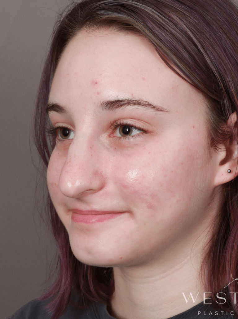 Before Image: Open Rhinoplasty (8.5 Months Post-op) - left-front-oblique