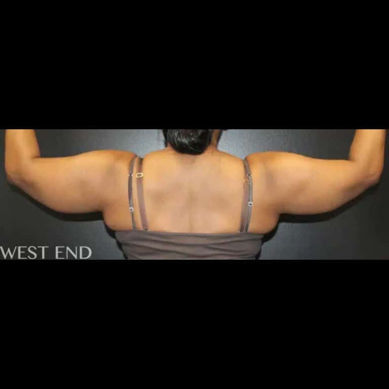 Before Image: Liposuction and Renuvion Skin Tightening - back