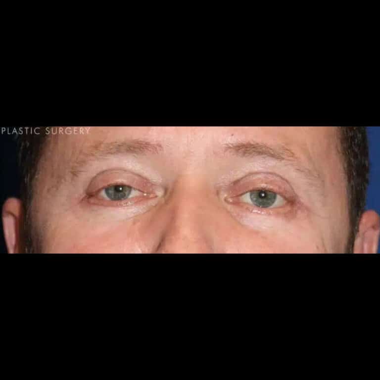 After Image: Lower & Upper Blepharoplasty - front