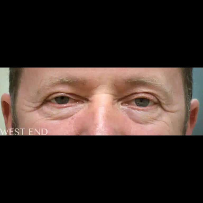 Before Image: Lower & Upper Blepharoplasty - front