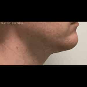 After Image: Kybella