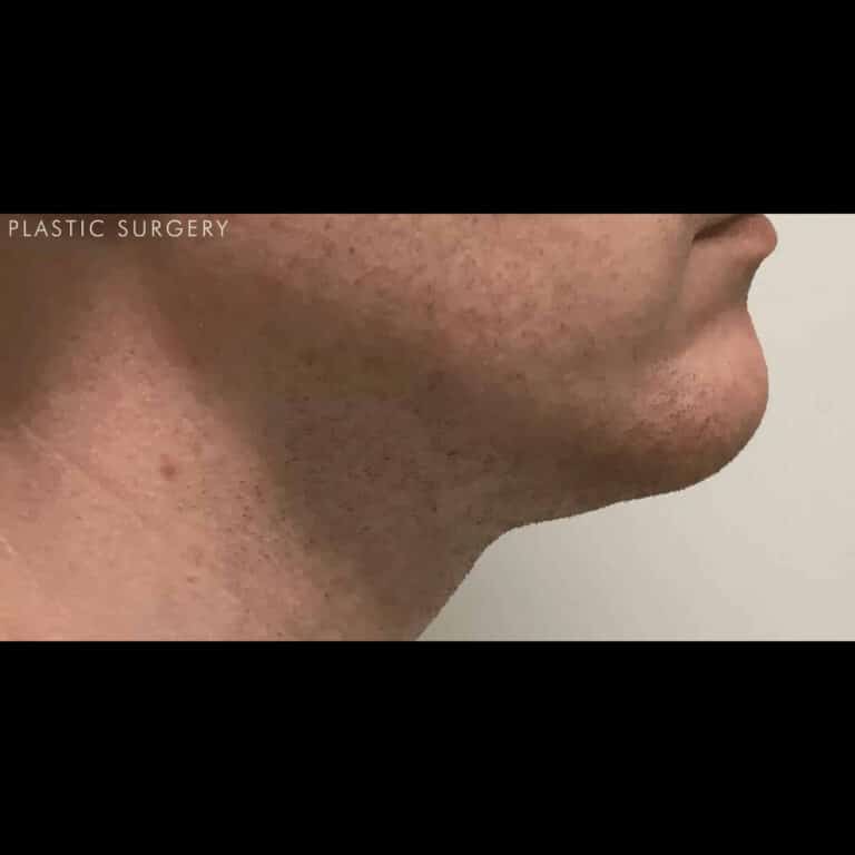After Image: Kybella - right-side