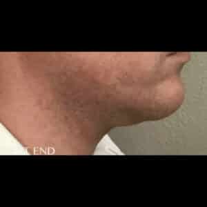 Before Image: Kybella